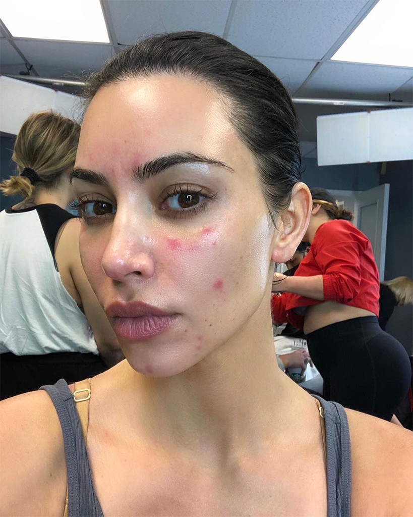 Kim Kardashian, Psoriasis, Instagram Kim Kardashian, Psoriasis, Instagram